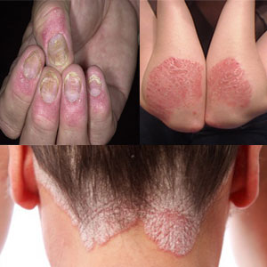 Atopichesky la dermatitis la conclusión al compendio